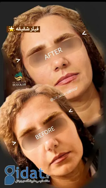 نمونه فیلر شقیقه دکتر سمانه فتوحی